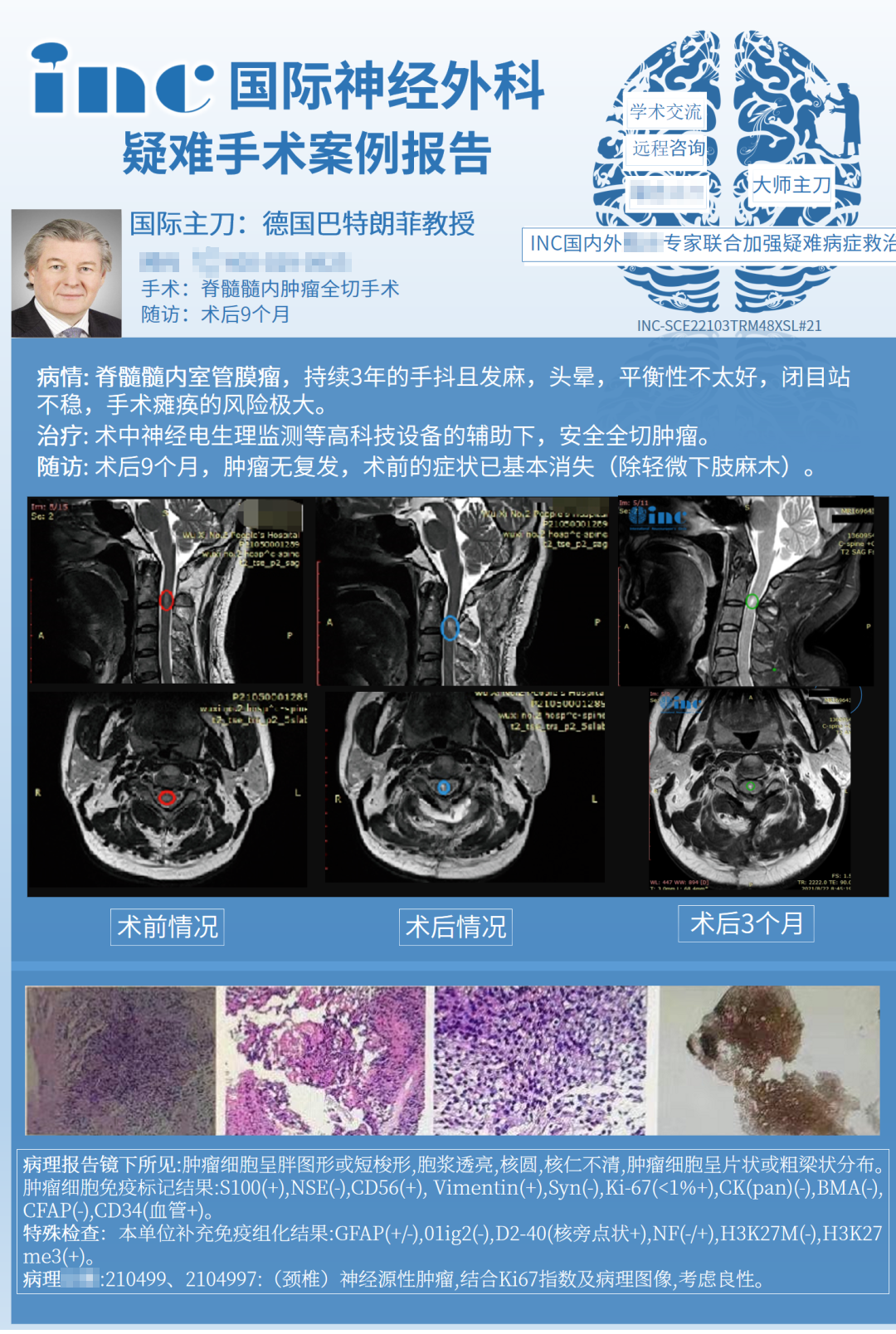 脊髓肿瘤常见类型有哪些？INC德国巴教授脊髓肿瘤实例交流