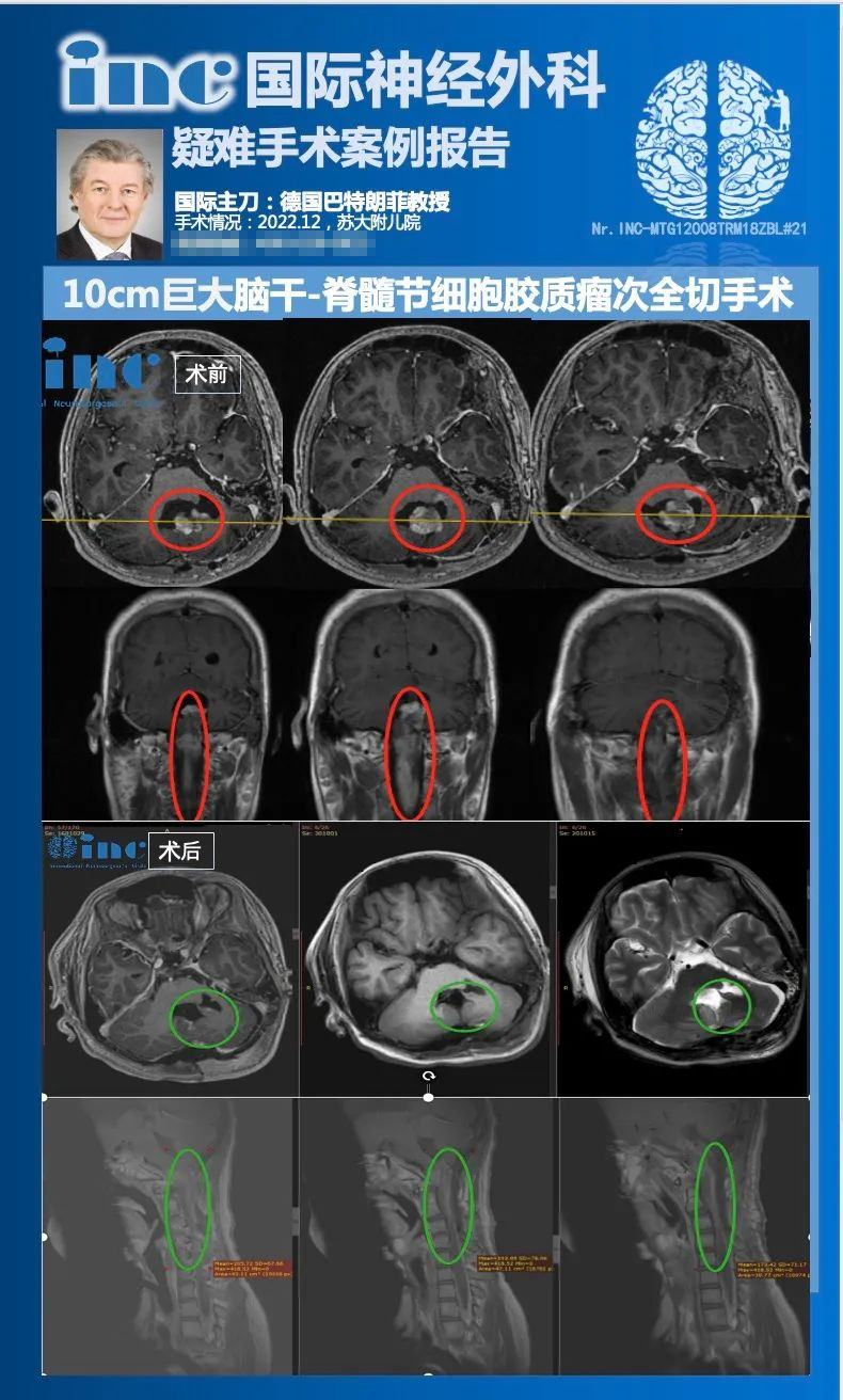 儿童脊髓肿瘤是什么病？儿童脊髓胶质瘤能治好吗？