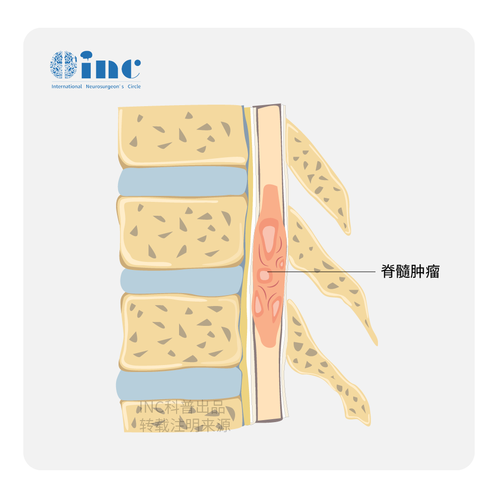 什么是椎管内肿瘤?