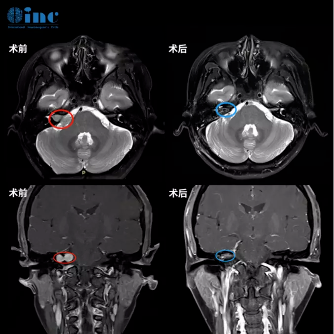 听神经瘤四级了还有救吗？听神经瘤手术案例分享