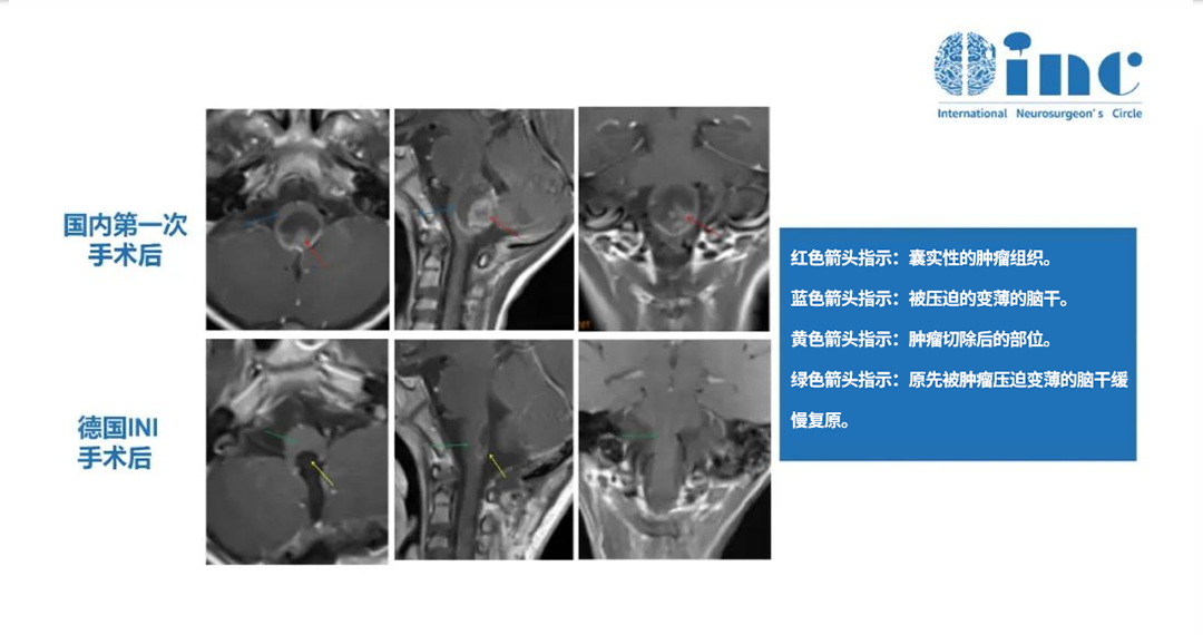 颅内室管膜瘤是良性的吗？INC颅内室管膜瘤案例