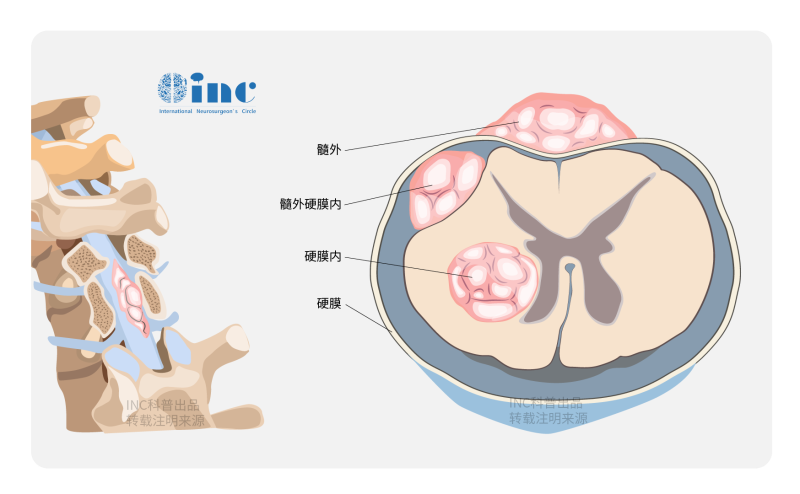 脊髓星形细胞瘤是良性的吗？如何治疗？