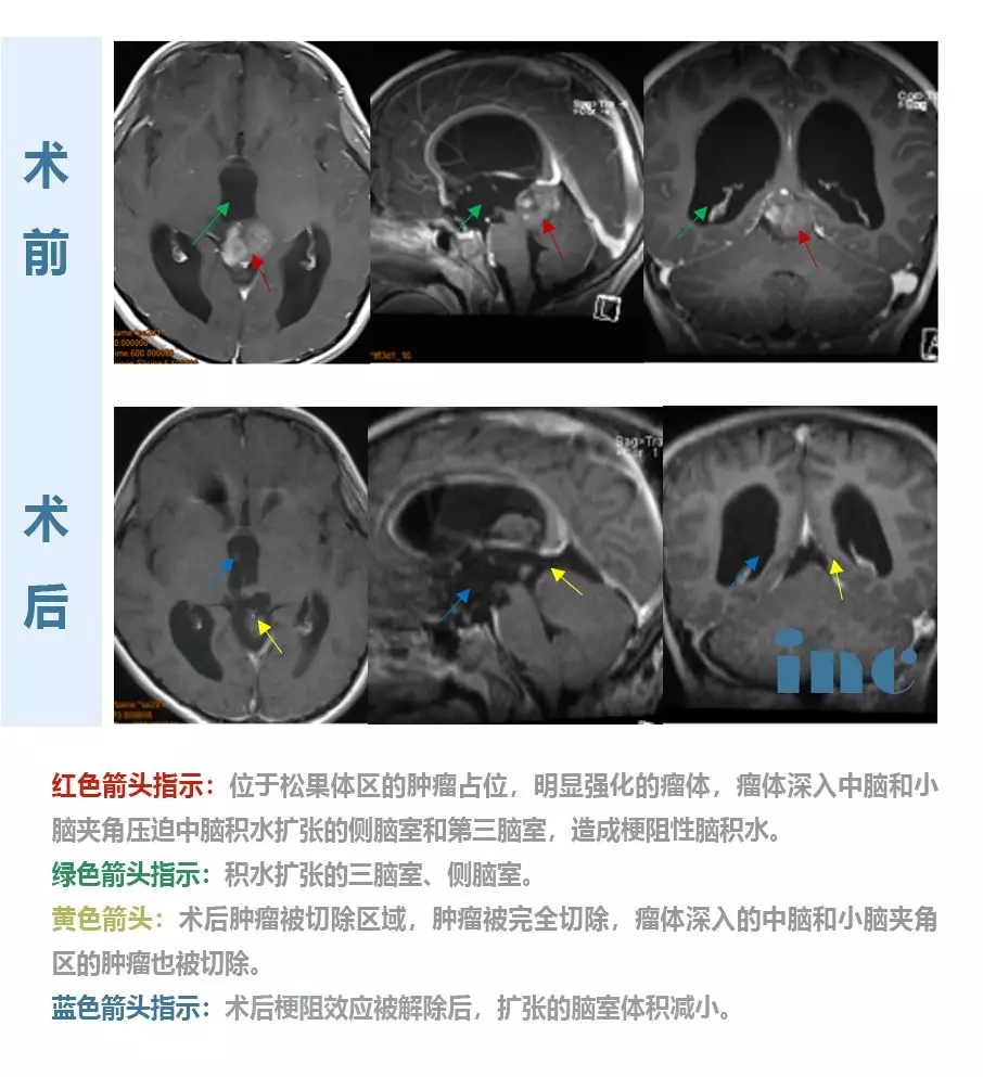 松果体肿瘤手术风险大吗？INC国