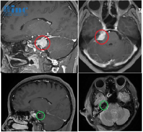 小型桥小脑角区脑膜瘤手术还是放疗？