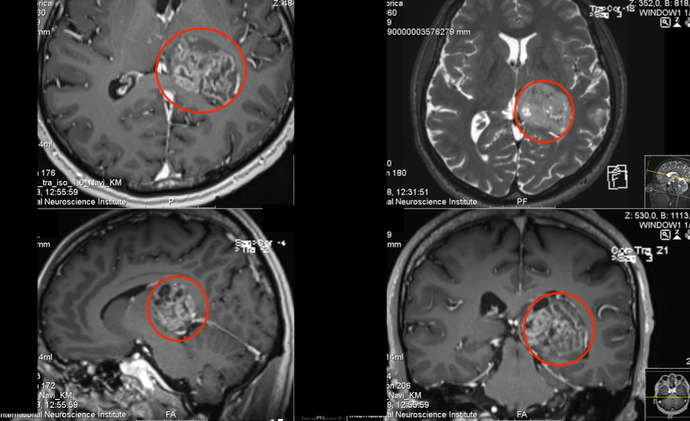 INC国际教授丘脑胶质瘤案例分享