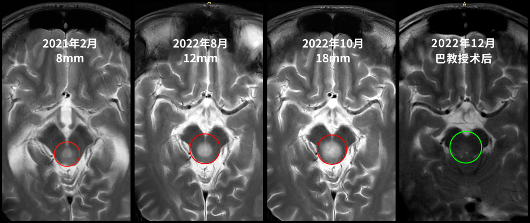 INC中脑顶盖胶质瘤实例分享：2