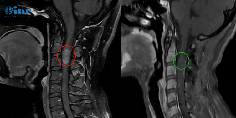 【INC德国巴教授脊髓髓内肿瘤案例】致瘫、致残……脊髓髓内肿瘤，毫厘之间见分晓