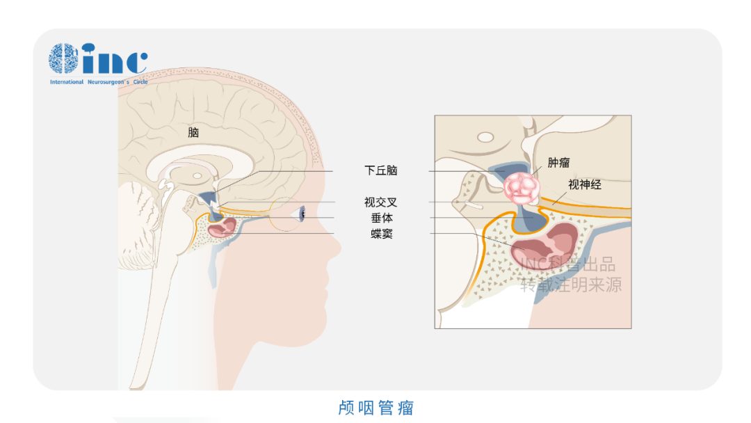 垂体柄是什么？保护垂体柄在颅