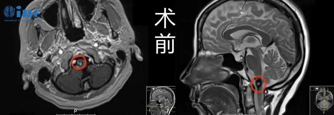 中年女士脑干海绵状血管瘤前后三次出血脑干组织受损，赴德安全全切手术