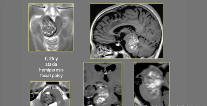 脑血管瘤案例图片