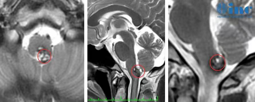 brainstem cavernoma