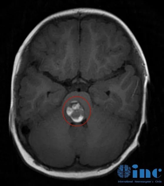 1.5 year old boy with brainstem cavernoma,Three years after surgery