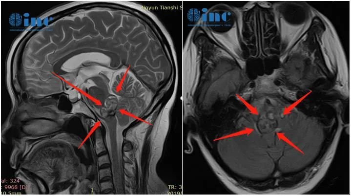 Pre-operative MRI images of Doctor Cooper's brainstem cavernoma