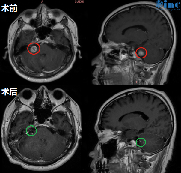 半年突聋两次、听神经瘤侵入内听道，保面听全切术后大学教授笑对讲台、投身科研