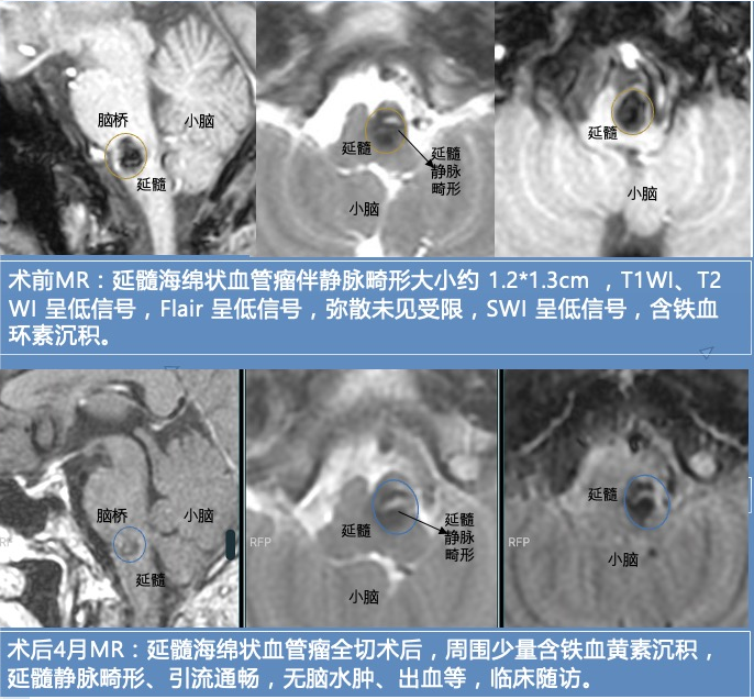 脑干海绵状血管瘤的静脉畸形需要处理吗？不用做手术吗？