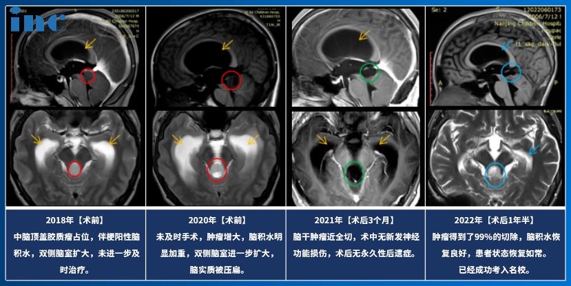 脑干胶质瘤保守治疗2年肿瘤压扁大脑，INC国际教授术后恢复如常