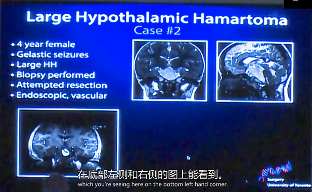 丘脑错构瘤是什么病？国际癫痫手术教授Rutka教授LITT治疗成功案例交流