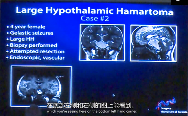 丘脑错构瘤是什么病？世界癫痫手术大师Rutka教授LITT治疗成功案例分享