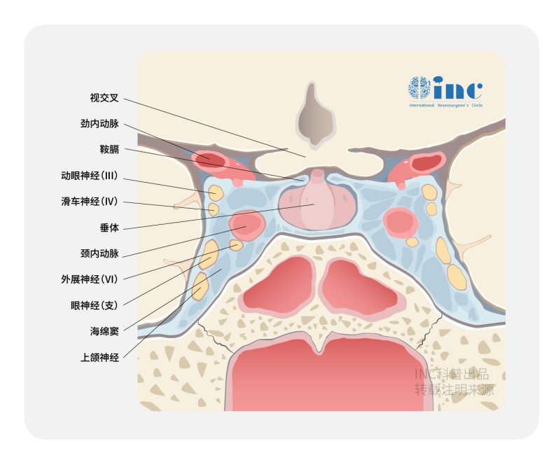 右眼失明17年，如何全切海绵窦脑膜瘤并保残存视力？