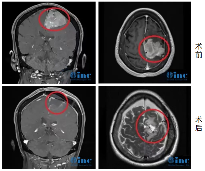 大脑镰旁脑膜瘤肿瘤大、易复发，如何破解全切难题？