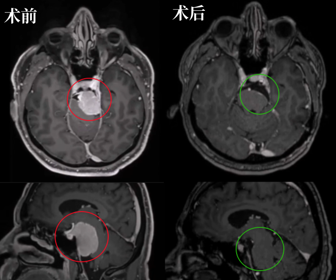 54岁男性巨大岩斜区脑膜瘤压迫脑干痛不欲生，世界颅底手术大咖成功手术！