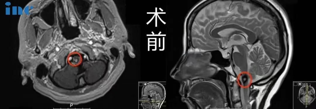 脑干海绵状血管瘤反复出血还有救吗？INC巴特朗菲教授脑干海绵状血管瘤经典案例合集