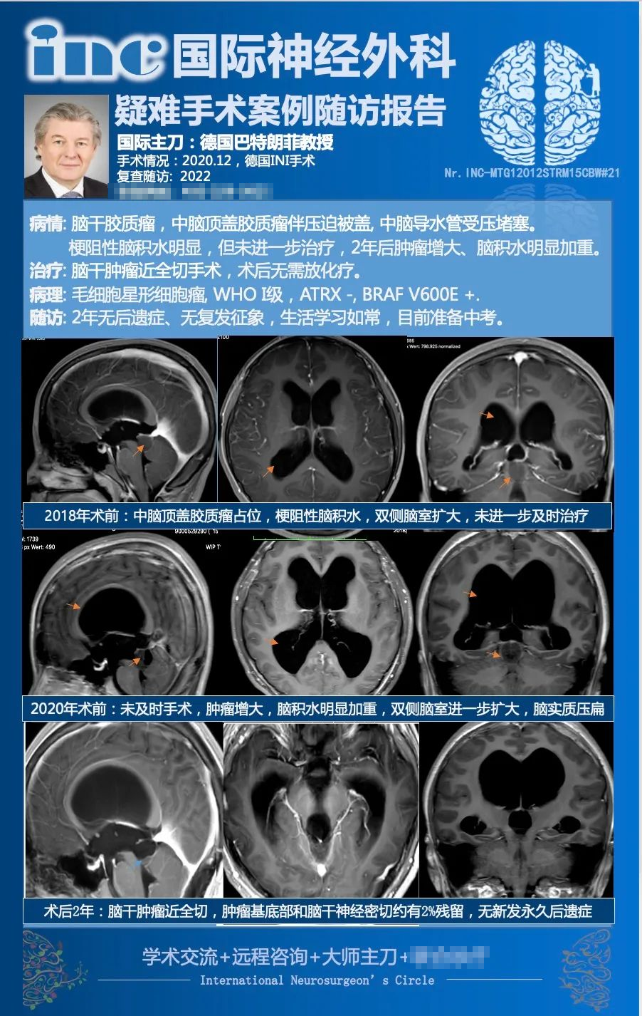 星形细胞瘤预后怎么样？INC国际