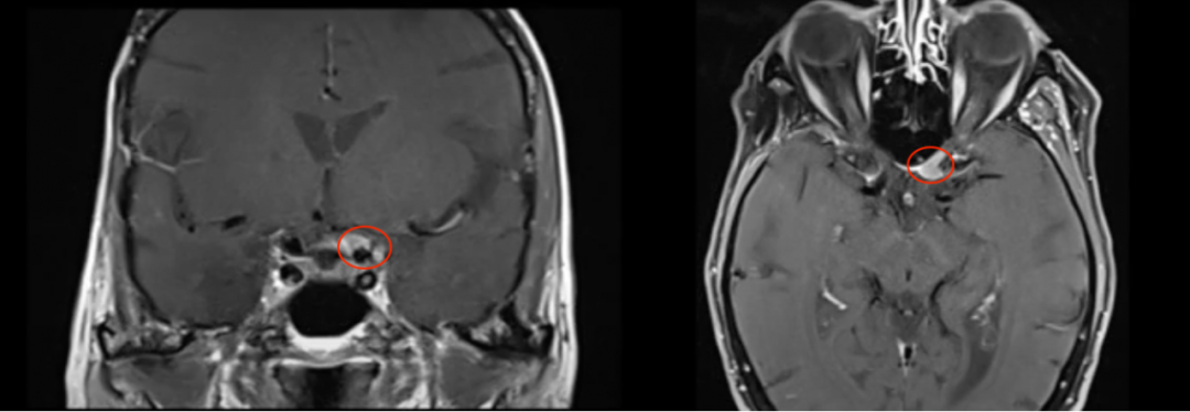 视力下降险失明竟患上视神经管脑膜瘤，INC法国Froelich教授如何全切、保视力？