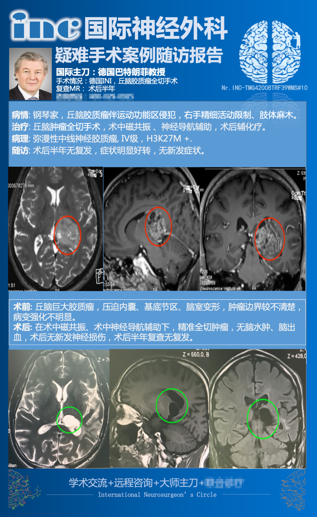 丘脑胶质瘤怎么治疗？INC国际教授手术案例