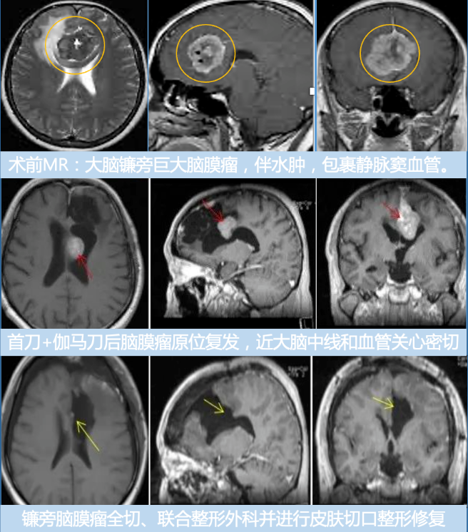 矢状窦旁脑膜瘤严重吗？脑膜瘤累及矢状窦首刀、伽马刀后多发恶化，第二刀如
