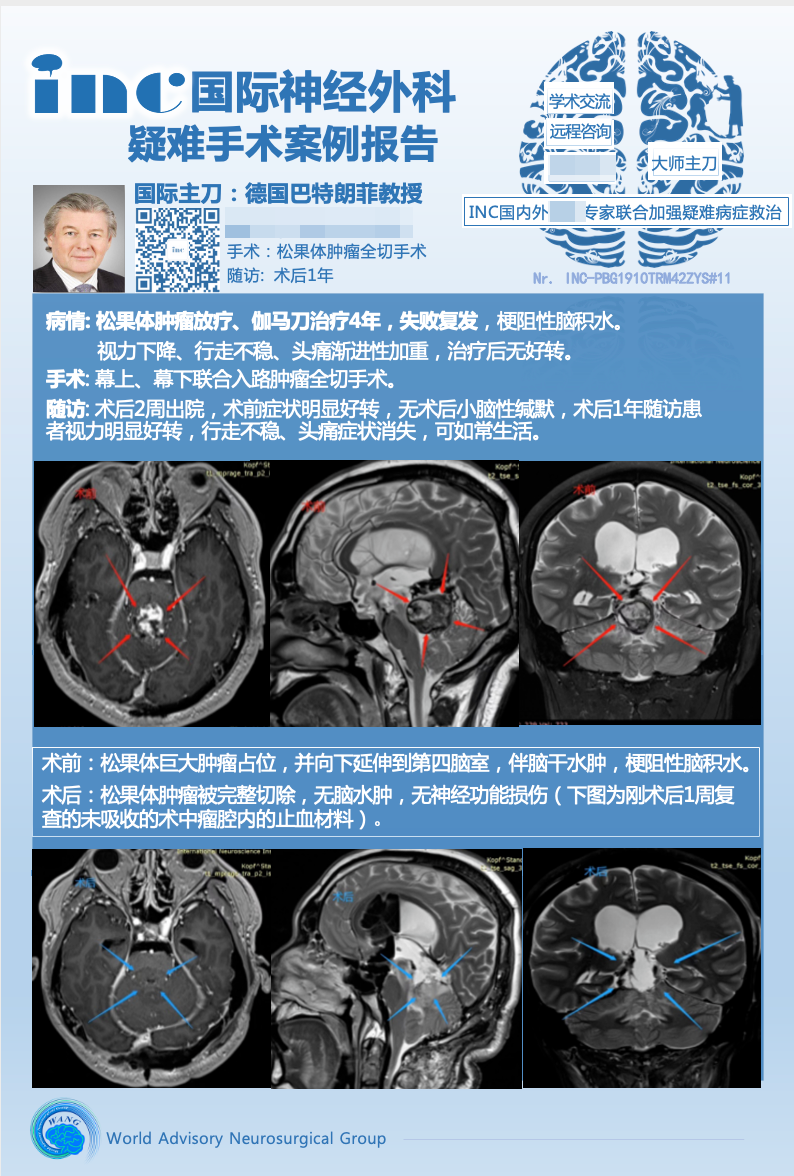 手术及反复放疗后复发，巨大松果体区肿瘤全切术后1年无复发