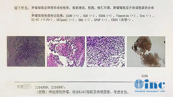 脊髓髓内肿瘤术后病理分析