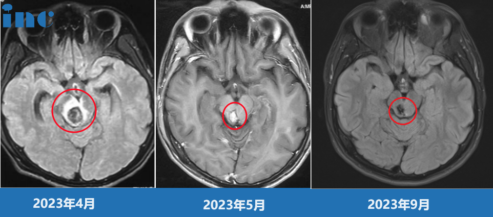 面瘫、话说不清、呛咳、走路不稳……巴教授脑干术后第1天全部缓解