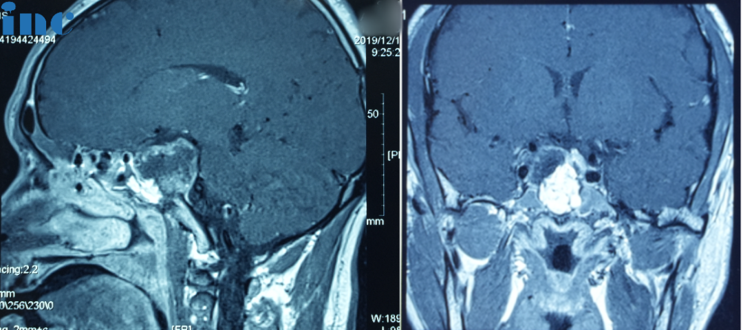 Chordoma of the sellar region,48-year-old male