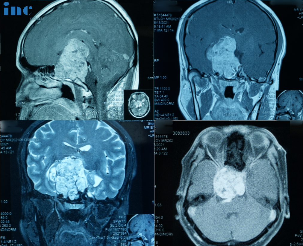 In 2021,Mr.Su again presented with vision loss and visual field deficits.A new MRI scan at his local hospital suggested a recurence of the chordoma.