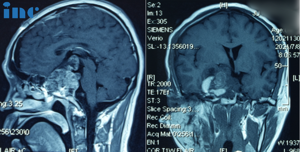 2023:Third surgery via transnasal endoscopic approach