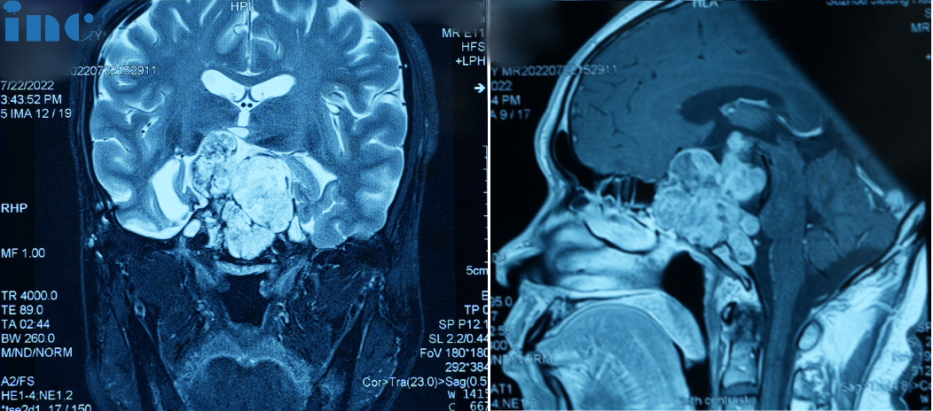 In July 2022,Mr.Su's vision related symptoms worsened again for the third time.An MRI scan revealed another recurence of his chordoma.