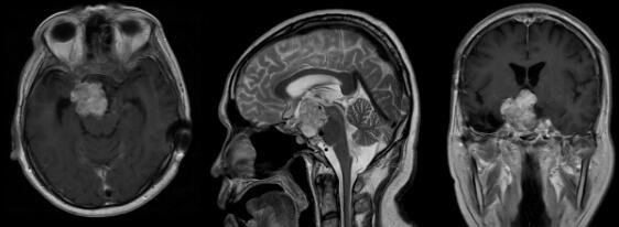 Pre-operative MRI:An extensive tumor can be seen,involving numerous structures in the skull base with erosion of the clivus