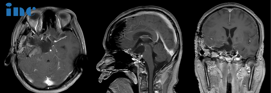 Post-operative MRI:The tumor was resected from the sellar and suprasellar regions,from the cavernous sinus and the third ventricle.The middle image shows an MRI artifact on the left.