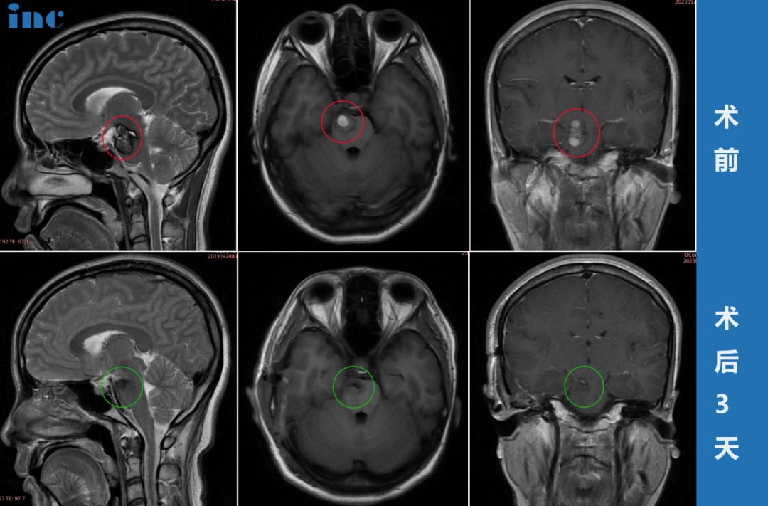 脑干-中脑及桥脑海绵状血管瘤