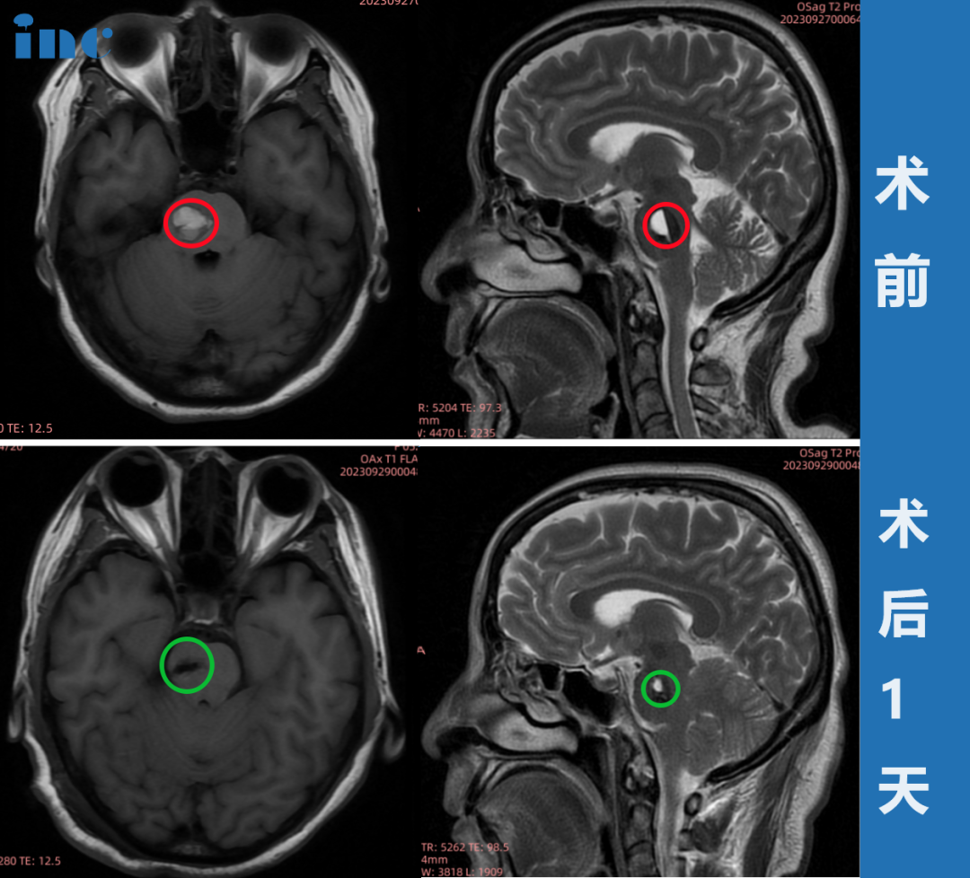 脑干-脑桥海绵状血管瘤