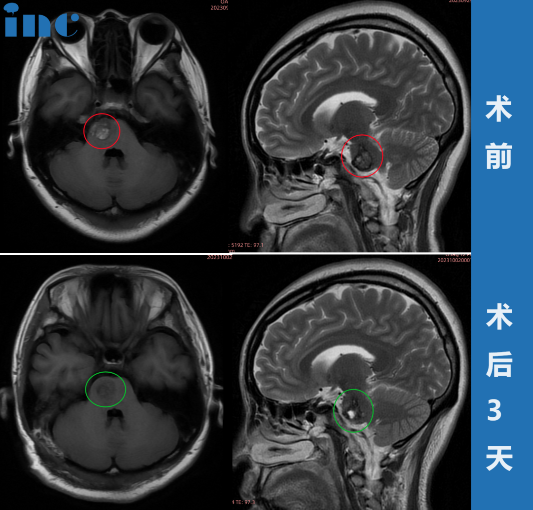 脑干-脑桥海绵状血管瘤