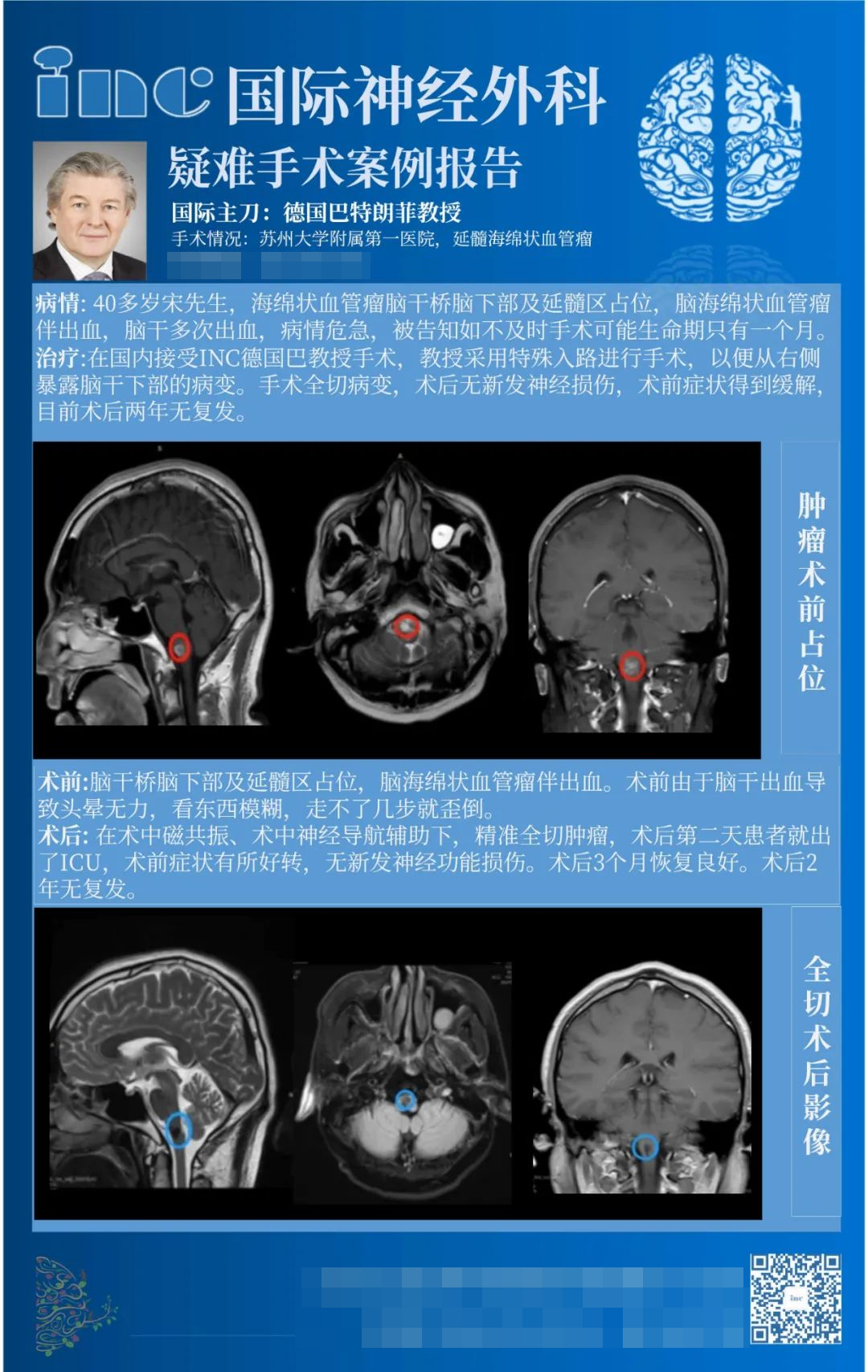 延髓海绵状血管瘤罕见吗？INC巴教授成功拯救40岁延髓海绵状血管瘤患者