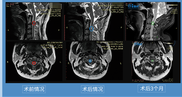 脊髓室管膜瘤是恶性的吗？40岁男性手术风险大全切肿瘤可能吗？