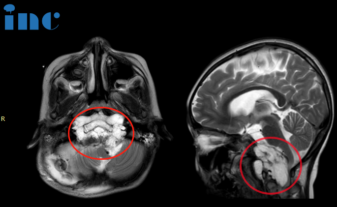 6岁仅重18kg-小小脑袋长出“苹果大”脊索瘤，INC福洛里希教授如何不开颅安全手术？