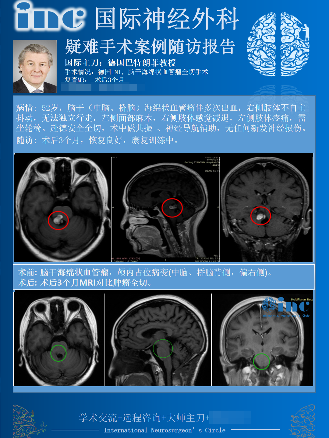 脑干海绵状血管瘤,巴特朗菲教授