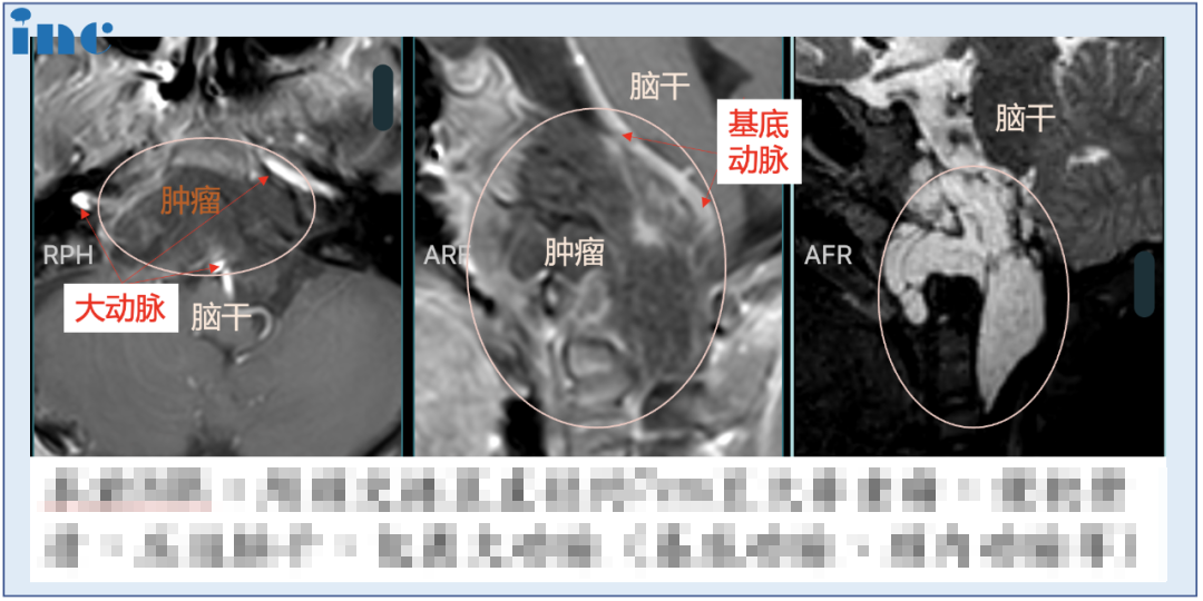 颅底脊索瘤,福洛里希,INC