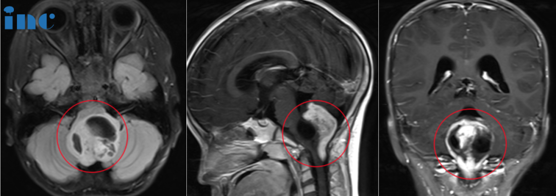 6岁半女孩——四脑室-小脑-颅颈交界处占位