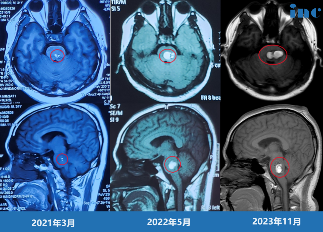 33岁男性-脑干（桥脑）海绵状血管瘤3次出血