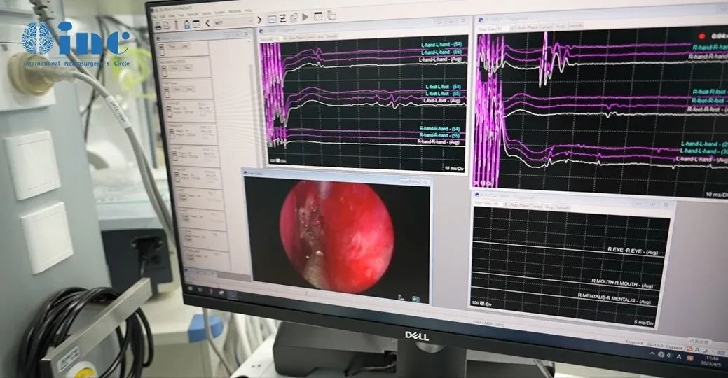 手术全程在神经电生理监测下安全进行